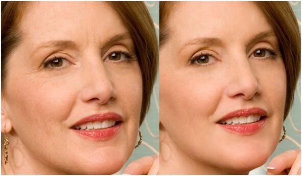 before and after plasma skin rejuvenation of the face