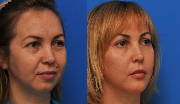 before and after skin rejuvenation with tightening photo 1