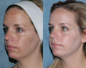 Photo before and after partial face resurfacing
