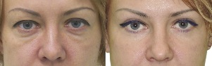 Images before and after contouring of eyelids