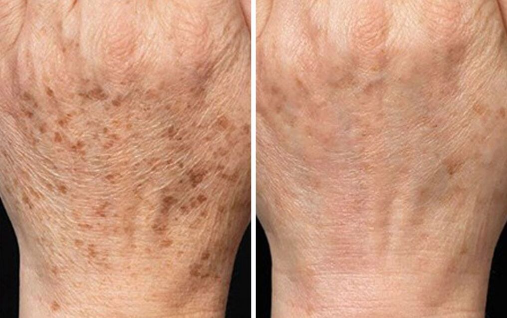 peeling of hands before and after photos